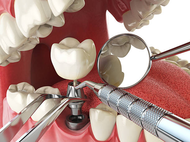 Best Emergency Root Canal Treatment in Steele Creek, AK